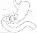 Fig. 01 - Implantable weight control device to promote early and prolonged satiety in a bariatric patient