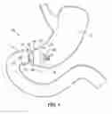 Fig. 02 - Implantable weight control device to promote early and prolonged satiety in a bariatric patient