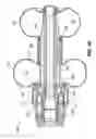 Fig. 23 - Implantable weight control device to promote early and prolonged satiety in a bariatric patient