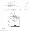 Fig. 06 - Treatment of nerve function using low pressure suction apparatus