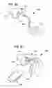 Fig. 35 - Treating sleep apnea with negative pressure