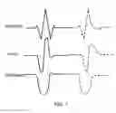 Fig. 06 - Method and apparatus for enhancement of chest compressions during CPR