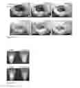 Fig. 20 - Kit and method for detecting porous dental hydroxyapatite