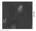 Fig. 14 - Unit dose of a cis-imidazoline for treating an osteoarthritic joint by removing senescent cells