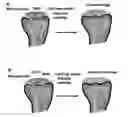 Fig. 01 - METHODS FOR REPAIRING CARTILAGE DAMAGE
