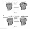 Fig. 02 - METHODS FOR REPAIRING CARTILAGE DAMAGE