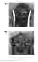 Fig. 16 - Thermosensitive biodegradable hydrogel