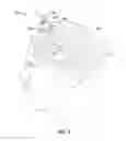 Fig. 04 - IMAGE-GUIDED IRRIGATING SUCTION CANNULA FOR REMOVAL OF INTRACEREBRAL HEMORRHAGE AND OTHER LESIONS