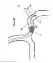 Fig. 11 - Systems and methods for controlling reperfusion in a vessel