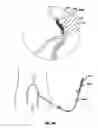 Fig. 26 - Systems and methods for controlling reperfusion in a vessel