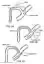 Fig. 05 - Devices and methods for alleviating lymphatic system congestion