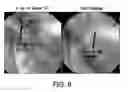 Fig. 13 - Devices and methods for alleviating lymphatic system congestion