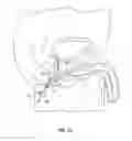 Fig. 07 - Intracavity balloon catheter