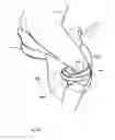 Fig. 07 - Horseman-securing device, saddle, and saddle securing device for preventing a horseman from falling off a four-legged animal