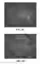 Fig. 10 - Microfluidic device and method for analysis of tumor cell microenvironments