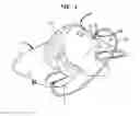 Fig. 02 - Pillow containing fluid delivery system