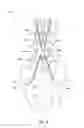 Fig. 09 - PERCUTANEOUS SYSTEM AND METHODS FOR ENHANCED EPIDURAL ACCESS FOR SPINE SURGERY
