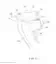 Fig. 09 - Minimally invasive crimp and cable for bone cerclage