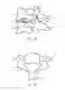 Fig. 02 - Intervertebral disc implant and method for restoring function to a damaged functional spinal unit