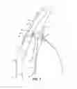 Fig. 02 - INTRAOCULAR IMPLANTS AND RELATED KITS AND METHODS