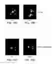 Fig. 22 - IMAGING AND THERAPY OF VIRUS-ASSOCIATED TUMORS