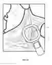 Fig. 02 - Control of vagal stimulation