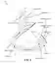 Fig. 03 - Surgical ligation clip