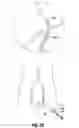 Fig. 06 - Aspiration system for thrombectomy procedures
