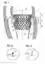 Fig. 02 - Transcatheter valve prosthesis