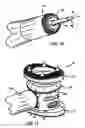 Fig. 06 - Expandable vertebral prosthesis