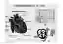 Fig. 02 - Method for positioning terminal end of pacemaker lead, which has passed through coronary sinus, in interventricular septum