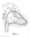Fig. 02 - Interventional medical systems