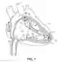 Fig. 02 - Compact implantable medical device and delivery device