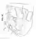 Fig. 09 - Cleats, Cleated Sole Structures, Molds and Molding Methods for In-Molding Articles