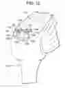 Fig. 22 - Soft tissue fixation repair methods using tissue augmentation constructs