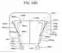 Fig. 72 - Soft tissue fixation repair methods using tissue augmentation constructs