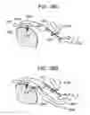 Fig. 79 - Soft tissue fixation repair methods using tissue augmentation constructs