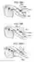 Fig. 80 - Soft tissue fixation repair methods using tissue augmentation constructs
