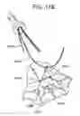 Fig. 83 - Soft tissue fixation repair methods using tissue augmentation constructs