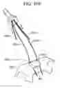 Fig. 86 - Soft tissue fixation repair methods using tissue augmentation constructs