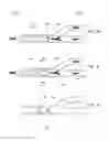 Fig. 07 - Methods of use of a balloon-tip aspiration catheter for ischemic stroke interventions