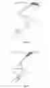 Fig. 02 - Clot removal device