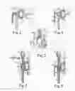 Fig. 03 - Device for external orthopedic fixations