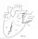 Fig. 04 - Methods of treating a cardiac arrhythmia by thoracoscopic production of a Cox maze III lesion set