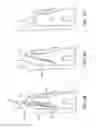 Fig. 72 - Laser-assisted periodontics