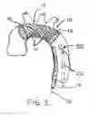 Fig. 02 - Embolic protection device