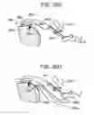 Fig. 79 - Soft tissue fixation repair methods using tissue augmentation scaffolds