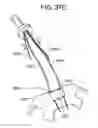 Fig. 86 - Soft tissue fixation repair methods using tissue augmentation scaffolds