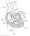 Fig. 02 - Devices, systems, and methods for reshaping a heart valve anulus, including the use of a bridge implant having an adjustable bridge stop