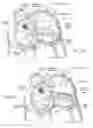 Fig. 06 - Devices, systems, and methods for reshaping a heart valve anulus, including the use of a bridge implant having an adjustable bridge stop